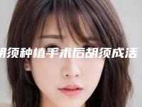 胡须种植手术后胡须成活问题